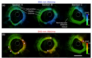 Fig. 2[1] ヒト冠動脈サンプルのイメージング結果。輝度はOCT後方散乱強度、色相はFLImで平均化した寿命に対応する。（a）は390nmのスペクトルバンド、（b）は540nmのスペクトルバンドに対応する。OCTによる深さ情報の取得により、血管周囲の脂肪細胞を含む健常部位の血管壁全体を可視化することができる。